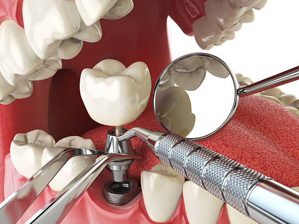 Best Emergency Root Canal Treatment in Mill Hall, PA